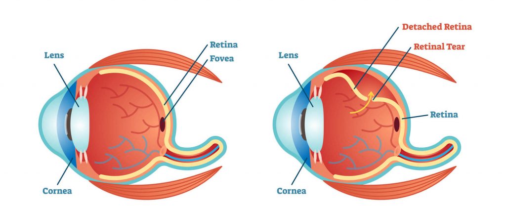 tudo sobre o descolamento de retina