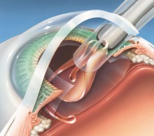 momento do implante de lente na cirurgia de catarata