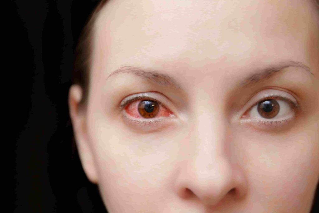 A imagem mostra o rosto de uma mulher com o olho avermelhado, demonstrando que está com esclerite.