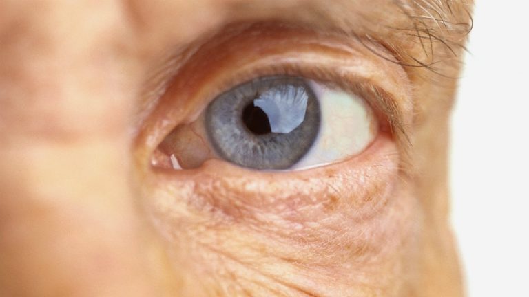 Como prevenir a catarata
