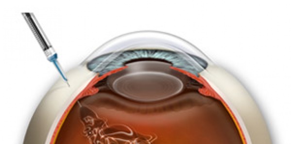 desenho de um olho mostrando realização de injeção intravítrea