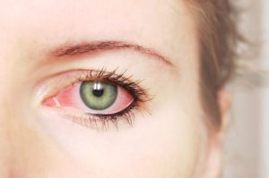 O que causa olhos vermelhos?