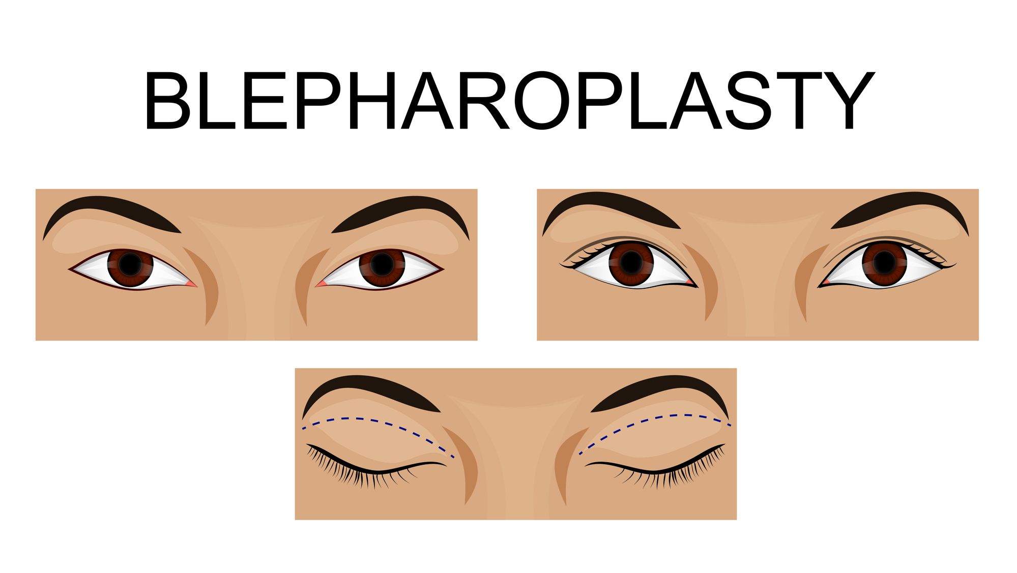 Блефаропластика азиатских глаз схема