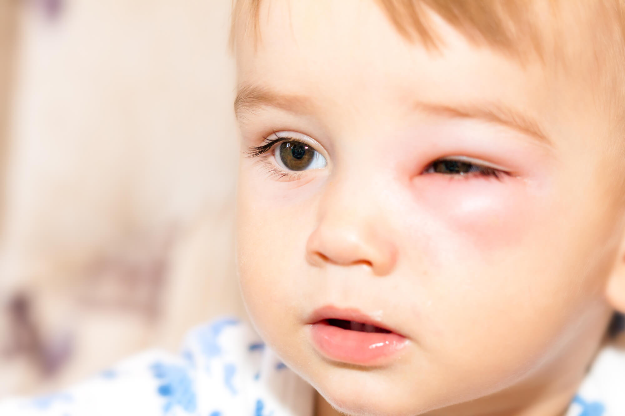 Припухлость у мальчика. Аллергический отек глаз у ребенка. Отёк Квинке на глазах у детей.