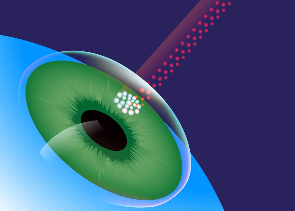 Terapie fotodinamică în oftalmologie, Ce este miopia senilă