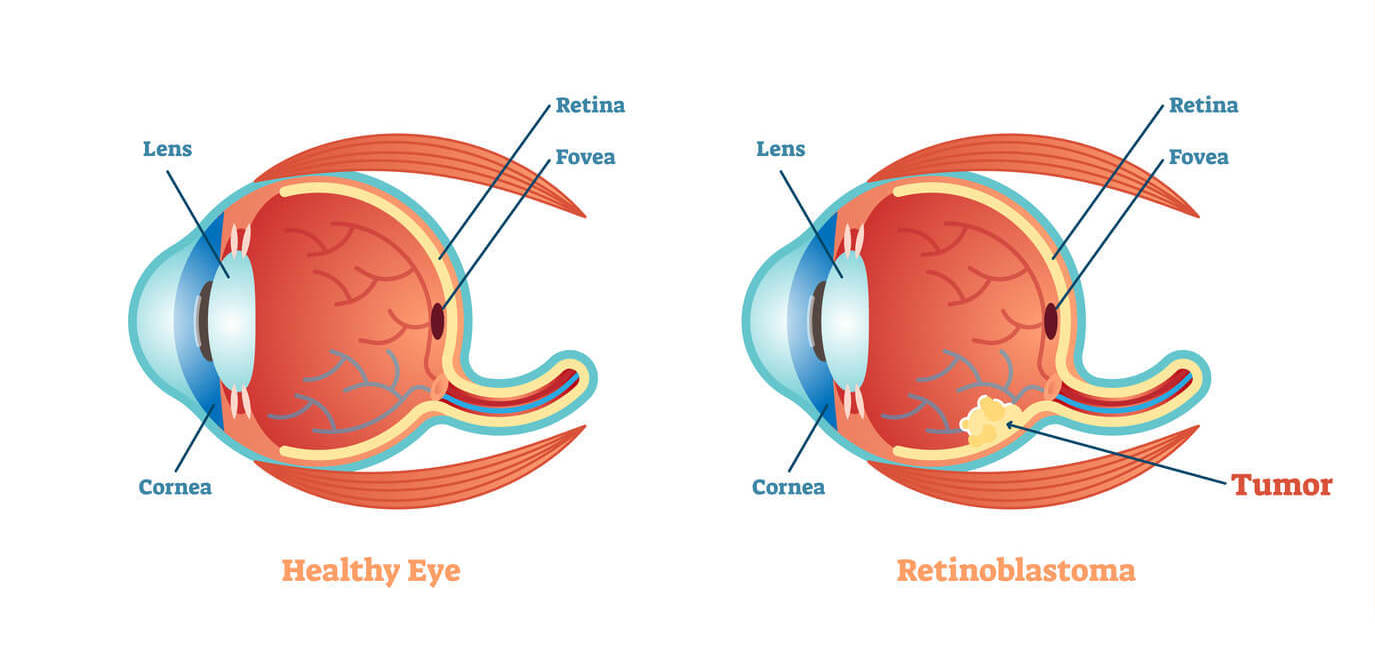 tudo sobre cancer nos olhos