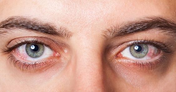 imagem de olhos de homem irritados com alergia