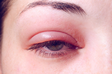 mulher com sintomas de blefarite em seu olho esquerdo