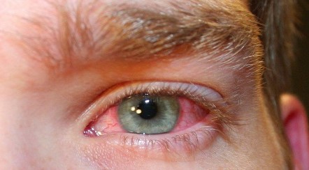 imagem de olhos com herpes ocular