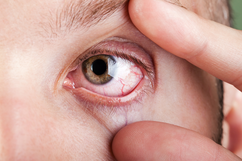 Vermelhidão nos olhos por trombose ocular