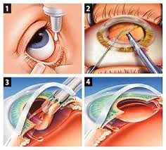 ilustração que mostra o processo da cirurgia de catarata