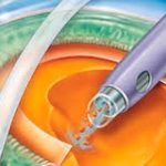 Inserção da nova lente intraocular