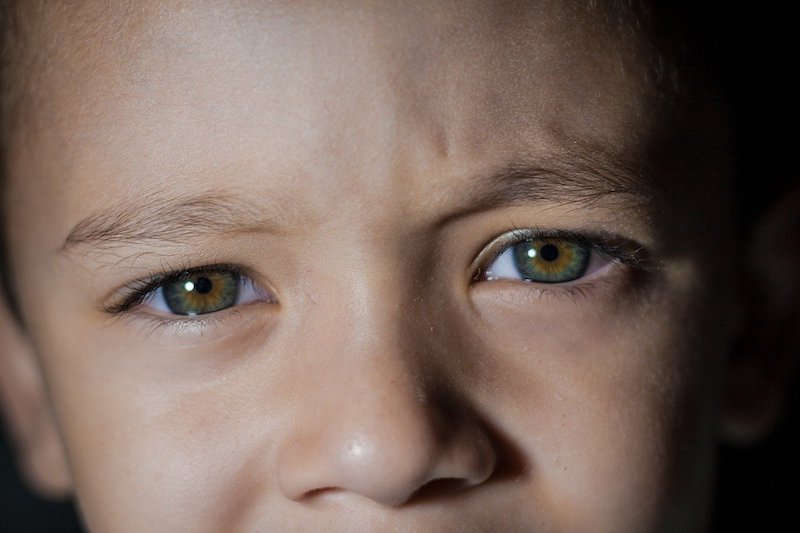 Criança de olhos verdes com sintomas de conjuntivite