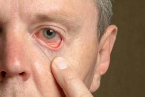 Um homem mostrando o olho irritado, provavelmente com a síndrome do olho seco.