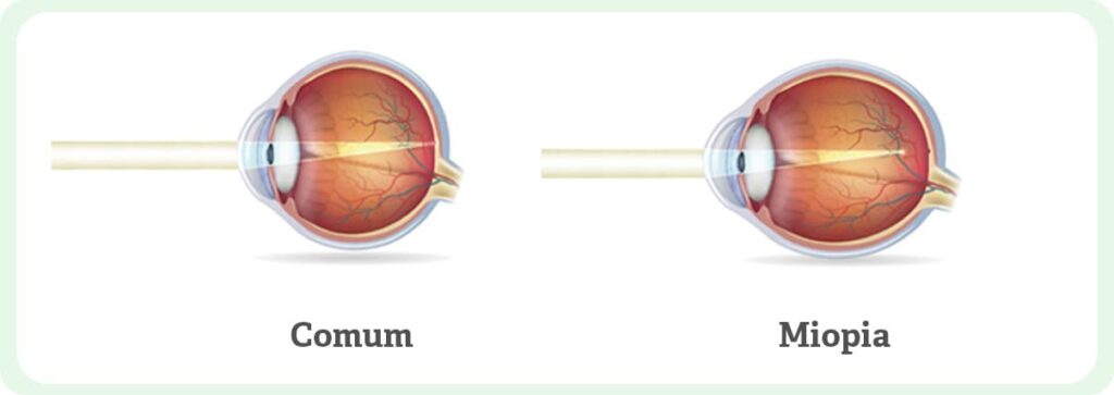 Imagem que mostra como é um olho com miopia e outro sem.