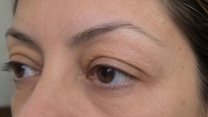 A imagem mostra um plano aproximado (close-up) da região dos olhos com blefaroplastia