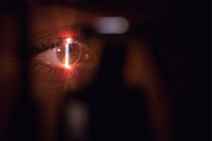 Esta imagem mostra uma examinação ocular com feixe de luz, tipicamente associada a procedimentos oftalmológicos como a fotocoagulação a laser ou exame com lâmpada de fenda.