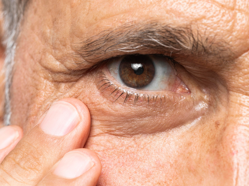 A imagem é um close-up detalhado do olho direito de uma pessoa, provavelmente um homem, de meia-idade ou mais velho. O foco está no olho e na área ao seu redor.