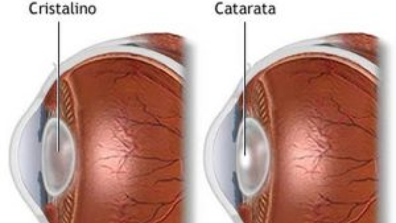 Uma ilustração médica que apresenta o corte anatômico lateral de dois olhos humanos para fins comparativos.