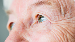 A imagem é um enquadramento em plano de pormenor (super close-up) focado nos olhos e na pele do rosto de uma pessoa idosa com glaucoma.