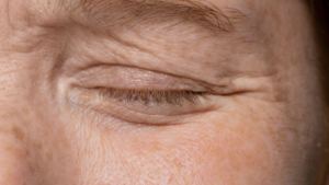 A blefaroplastia é uma cirurgia plástica (estética ou reparadora) destinada a remover o excesso de pele, gordura e/ou músculo das pálpebras superiores e inferiores.